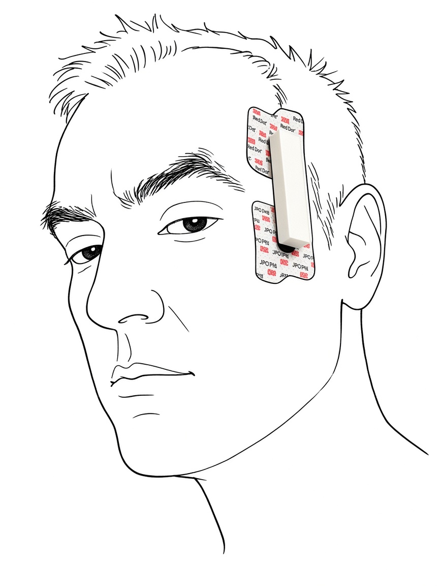 Oralable printed housing on the temple, seated on pads. Line drawing of the face; photograph of the device.